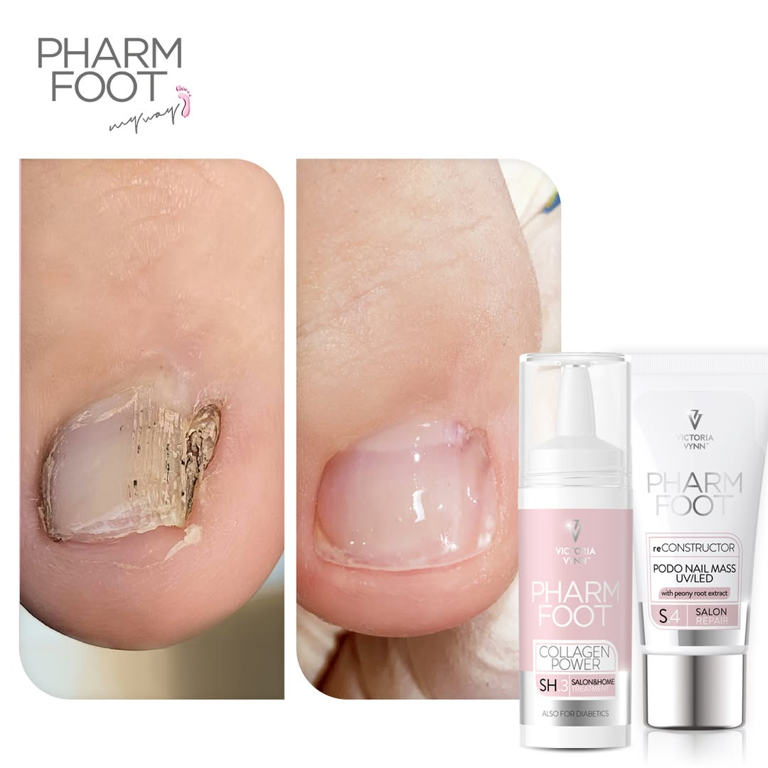 PHARM FOOT Nagu rekonstruktors , reConstructor Podo Nail Set UV/LED